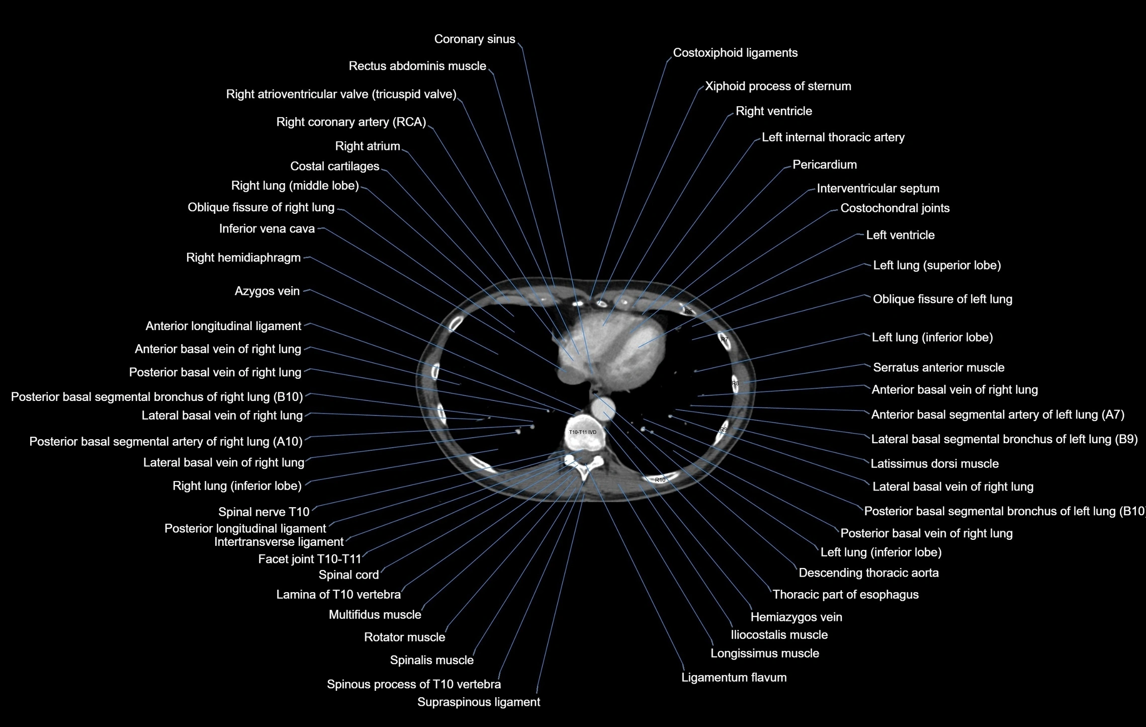 CT chest (thorax) labelled axial cross sectional anatomy radiology image-00092.webp